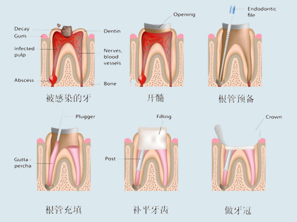 <b>根管治疗分几个步骤？</b>