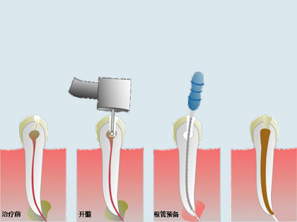 <b>根管治疗的治疗方法</b>