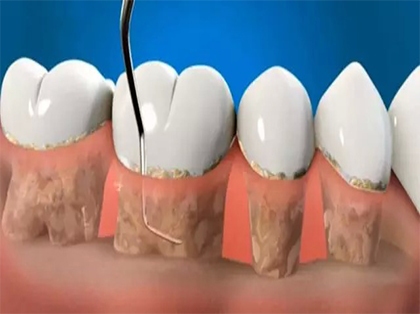 什么情况下需要做龈下刮治