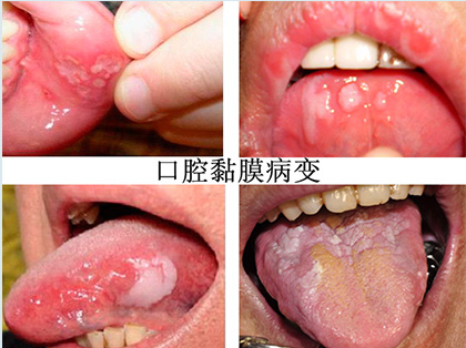 <b>口腔黏膜病的症状</b>
