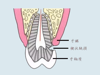 什么是楔状缺损