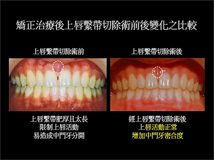 <b>什么是唇系带</b>