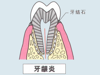 <b>牙龈炎的治疗方法</b>