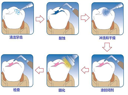 <b>窝沟封闭是怎么样的？</b>