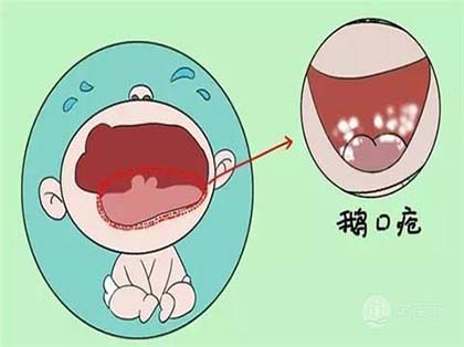 口腔念珠菌病的症状