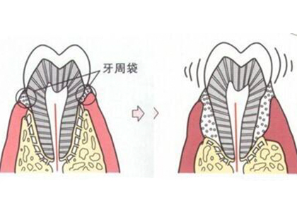 <b>牙龈萎缩可以修复？</b>