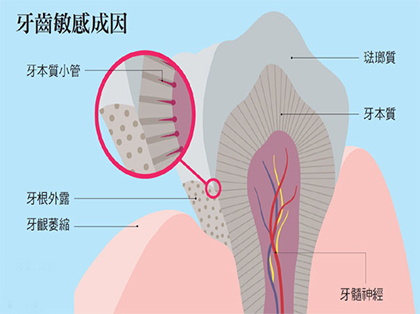 <b>牙齿敏感是怎么回事？</b>