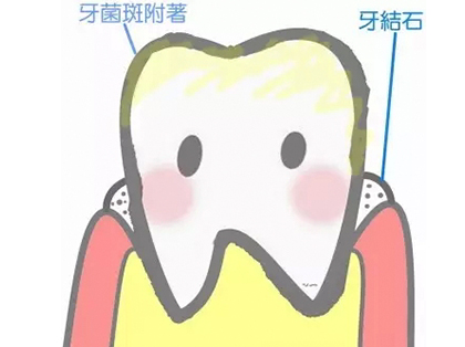 <b>牙结石是怎么形成的？</b>