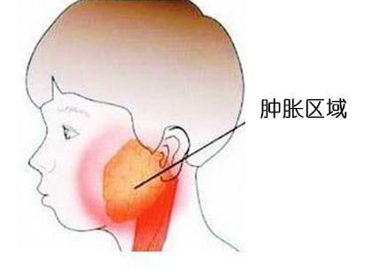 <b>什么是流行性腮腺炎？</b>