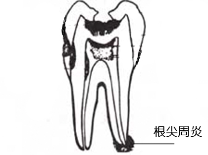 <b>儿童根尖周炎要怎么治疗？</b>