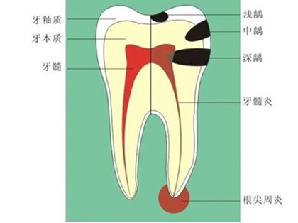 <b>根尖周炎吃什么药？</b>