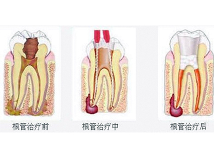 <b>根尖周炎有什么症状？</b>
