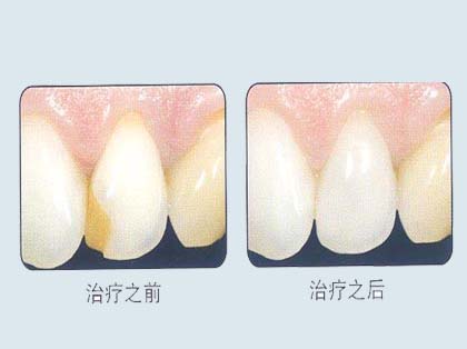 <b>楔状缺损的治疗方法</b>