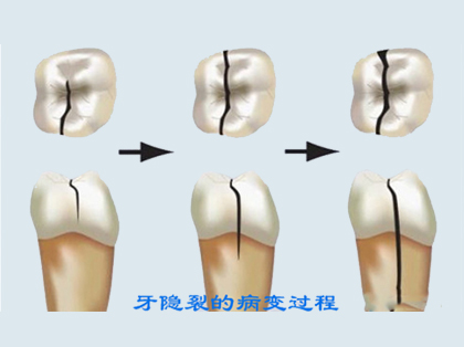 什么是牙隐裂