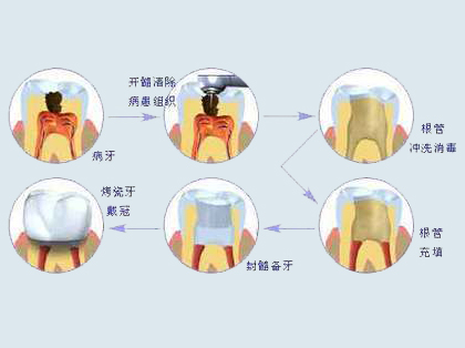 <b>牙髓炎的治疗方法</b>