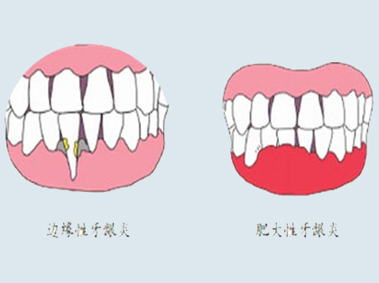 <b>牙龈炎的预防方法</b>