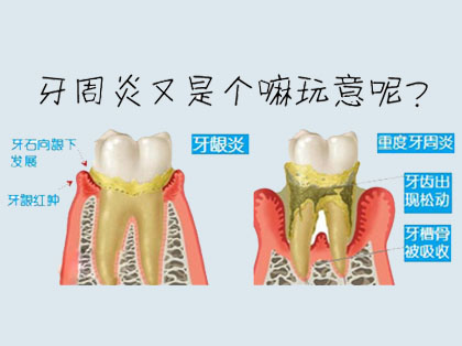 <b>什么是牙周炎</b>