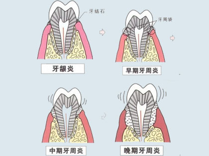 <b>牙周炎是怎么引起的</b>