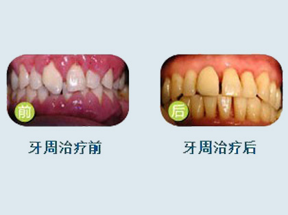 <b>牙周炎怎么治疗</b>