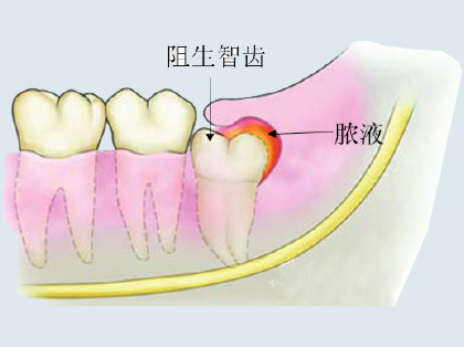<b>什么是智齿冠周炎</b>