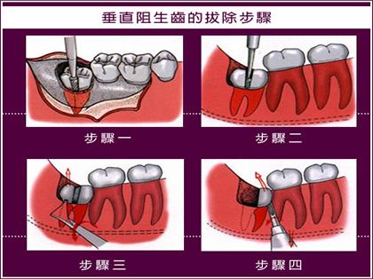 智齿冠周炎如何自我消炎