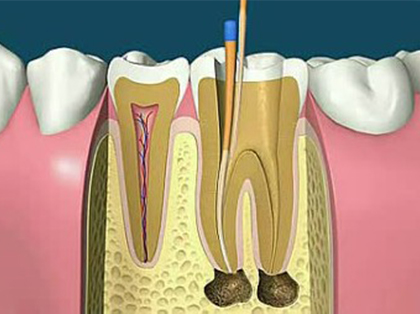 <b>根管治疗失败的表现</b>