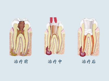 <b>根管治疗疼吗</b>