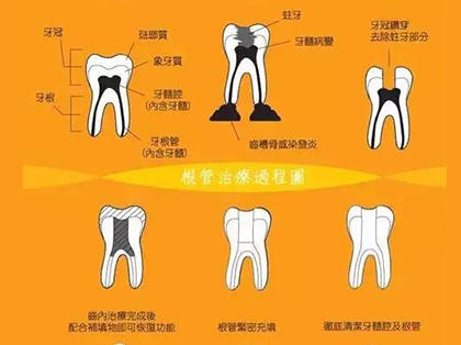 <b>什么情况下要做根管治疗</b>