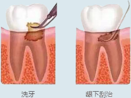 <b>龈下刮治全口都要做吗？</b>