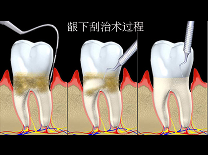 龈下刮治术步骤