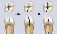 牙隐裂应该如何处理？