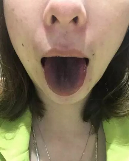 舌头被染上颜色怎么办？