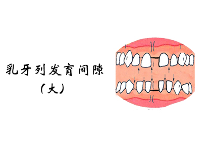 <b>牙缝大是什么原因，该怎么处理？</b>