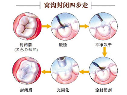 <b>小孩防龋是否要做窝沟封闭？</b>