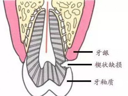 <b>为什么老年人的楔状缺损发病率那么高？</b>