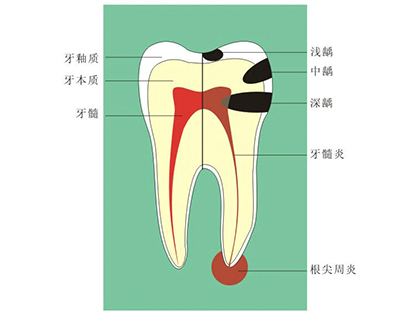 <b>成人出现龋齿应该要怎么做？</b>